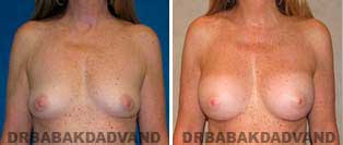 Breast Augmentation. Before and After Photos. 44 year old woman - frontal view