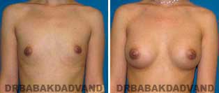 Breast Augmentation. Before and After Photos.23 year old woman - frontal view