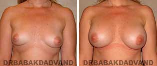 Breast Augmentation. Before and After Photos. 31 year old woman - front view