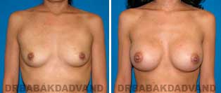 Breast Augmentation. Before & After Photos. 26 year old woman frontal view