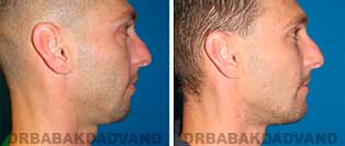 Chin Augmentation: Before and After Photos - man, right side view