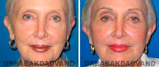 Face Before & After Photos. Facelift