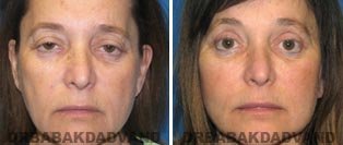 Facelift: Before and After Photos - 67 year old female