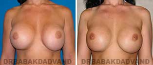 Revision Breast. Before & After Photos. 28 year old woman - front view