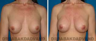 Revision Breast. Before & After Photos. 37 year old woman - front view