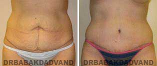 Tummy Tuck: Before and After Photos. 37 year old female - front view