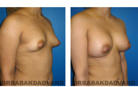 Before and After Photos. Breast-Augmentation:  - Woman, right side, oblique view
