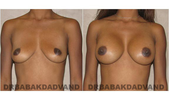 Before and After Photos. Breast-Augmentation: - front view 24yr old female 