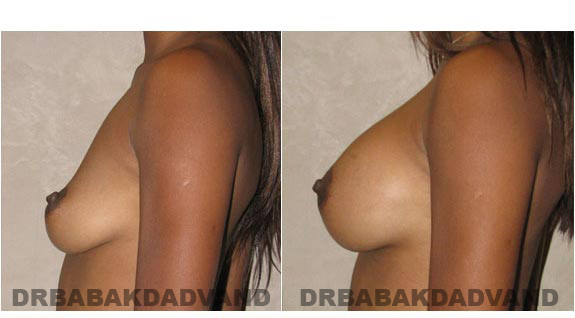 Before and After Photos. Breast-Augmentation: - left side view 24yr old female