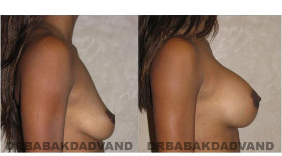 Before and After Photos. Breast-Augmentation: - right side view 24yr old female
