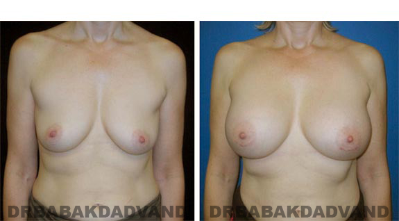 Before and After Photos. Breast-Augmentation: - front view 52 yr old woman
