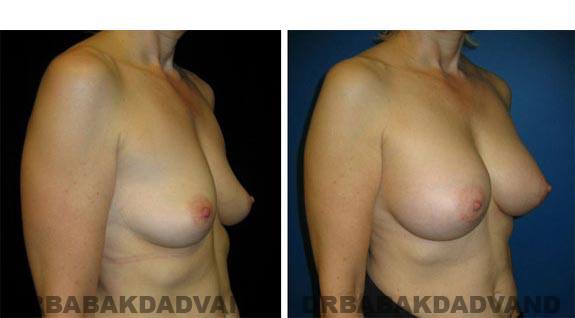 Before and After Photos. Breast-Augmentation: - right side, oblique view 52 yr old woman
