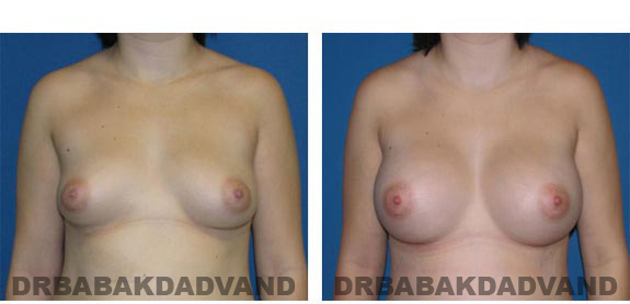 Before and After Photos. Breast-Augmentation: - front view 23 yr old female