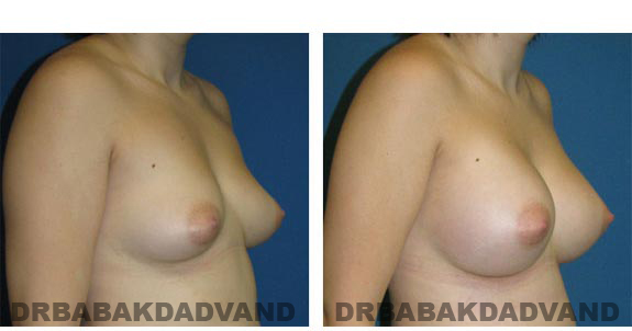 Before and After Photos. Breast-Augmentation: - right side, oblique view 23 yr old female