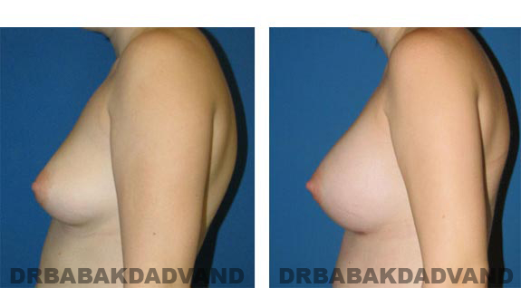 Before and After Photos. Breast-Augmentation: - left side view 23 yr old female