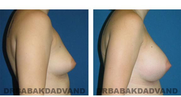 Before and After Photos. Breast-Augmentation: - rightside view 23 yr old female