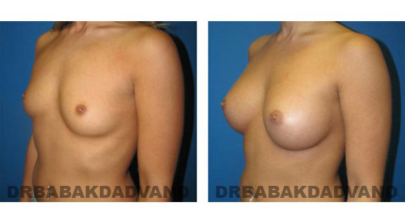 Before and After Photos. Breast-Augmentation: - left side, oblique view 23 yr old woman