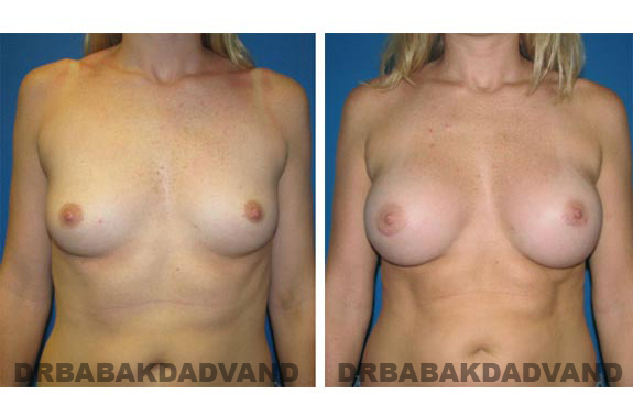 Before and After Photos. Breast-Augmentation: - front view 31 yr old woman