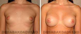 Gallery. Breast. Before and After Photos