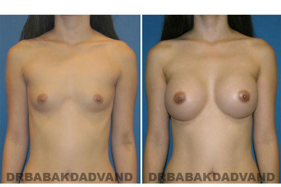 Before and After Photos. Breast-Augmentation: - front view 29 yr old woman