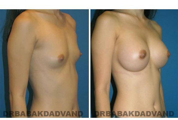 Before and After Photos. Breast-Augmentation: - right side, oblique view 29 yr old woman