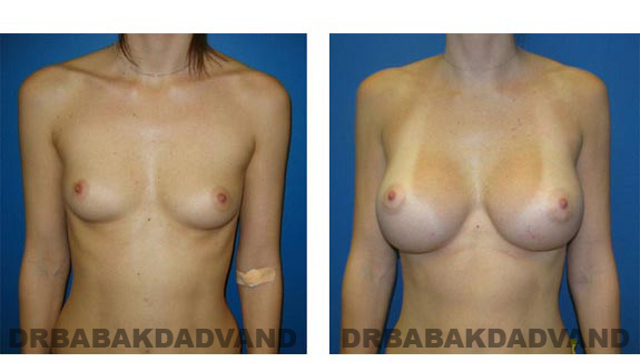 Before and After Photos. Breast-Augmentation: - front view 26 yr old woman
