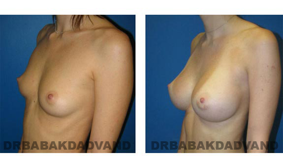 Before and After Photos. Breast-Augmentation: - left side, oblique view 26 yr old woman