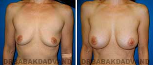 Breast Augmentation. Before & After Photos. 41 year old woman frontal view