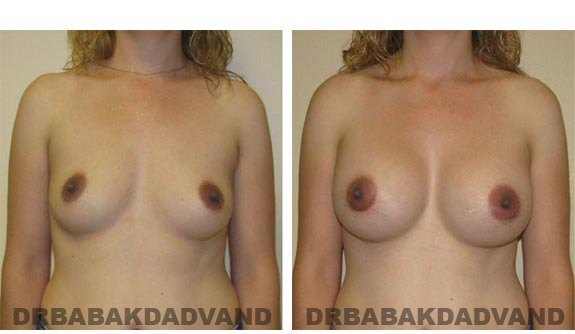 Before & After.Photos.Breast-Augmentation: Female, front view