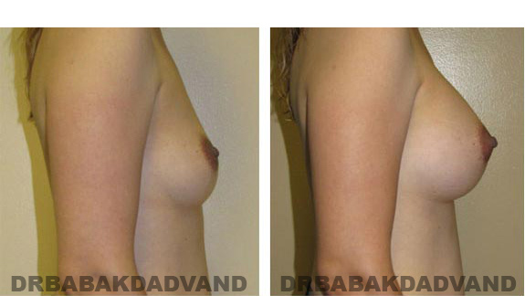 Before & After.Photos.Breast-Augmentation: Female, right side view
