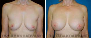 Breast Augmentation. Before & After Photos. 52 year old woman frontal view