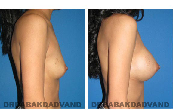 Before & After.Photos.Breast-Augmentation: Woman, left side view