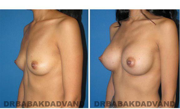 Before & After.Photos.Breast-Augmentation: Woman, right side, oblique view