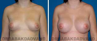 Breast Augmentation. Before & After Photos. 23 year old female frontal view