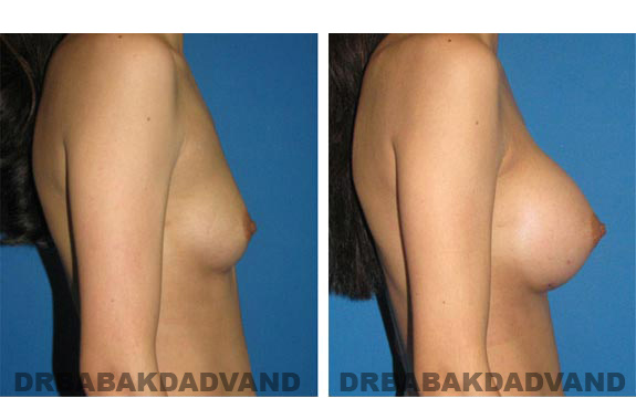 Before and After.Photos.Breast-Augmentation: Woman, right side view