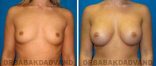 Breast Augmentation. Before & After Photos. 23 year old woman frontal view