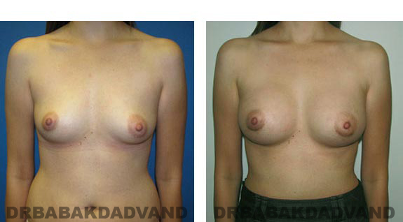 Before and After Photos. Breast-Augmentation: - 34 year old woman, front view