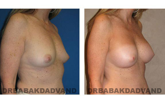 Before and After Photos. Breast-Augmentation: - 44 year old woman, right side oblique view