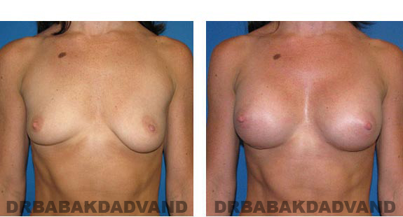 Before & After Photos. Breast-Augmentation: - 34 year old woman, front view