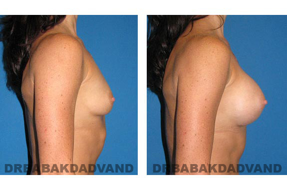 Before & After Photos. Breast-Augmentation: - 34 year old woman, right side view