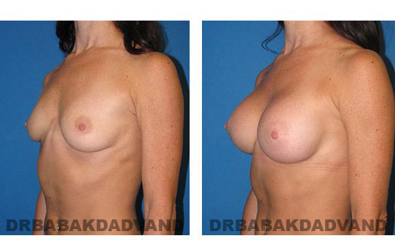 Before & After Photos. Breast-Augmentation: - 34 year old woman, left side oblique view