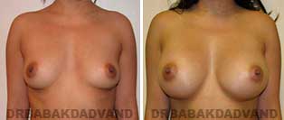 Breast Augmentation. Before & After Photos. 24 yr old woman frontal view