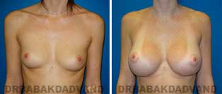 Breast Augmentation. Before and After Photos. 26 year old woman - frontal view