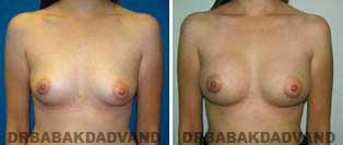 Breast Augmentation. Before and After Photos. 34 year old woman - frontal view