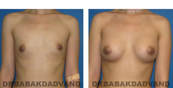 Before & After Photos. Breast-Augmentation: - 23 year old woman, front view