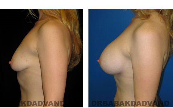 Before & After Photos. Breast-Augmentation: - 32 year old woman, left side view