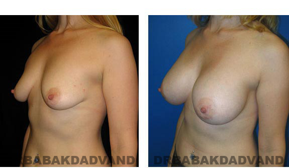 Before & After Photos. Breast-Augmentation: - 32 year old woman, left side oblique view