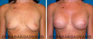 Breast Augmentation. Before & After Photos. 34 year old woman - frontal view