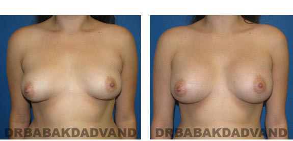 Before & After Photos. Breast-Augmentation: - 27 year old woman, front view