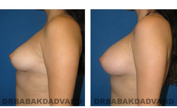 Before & After Photos. Breast-Augmentation: - 27 year old woman, left side view
